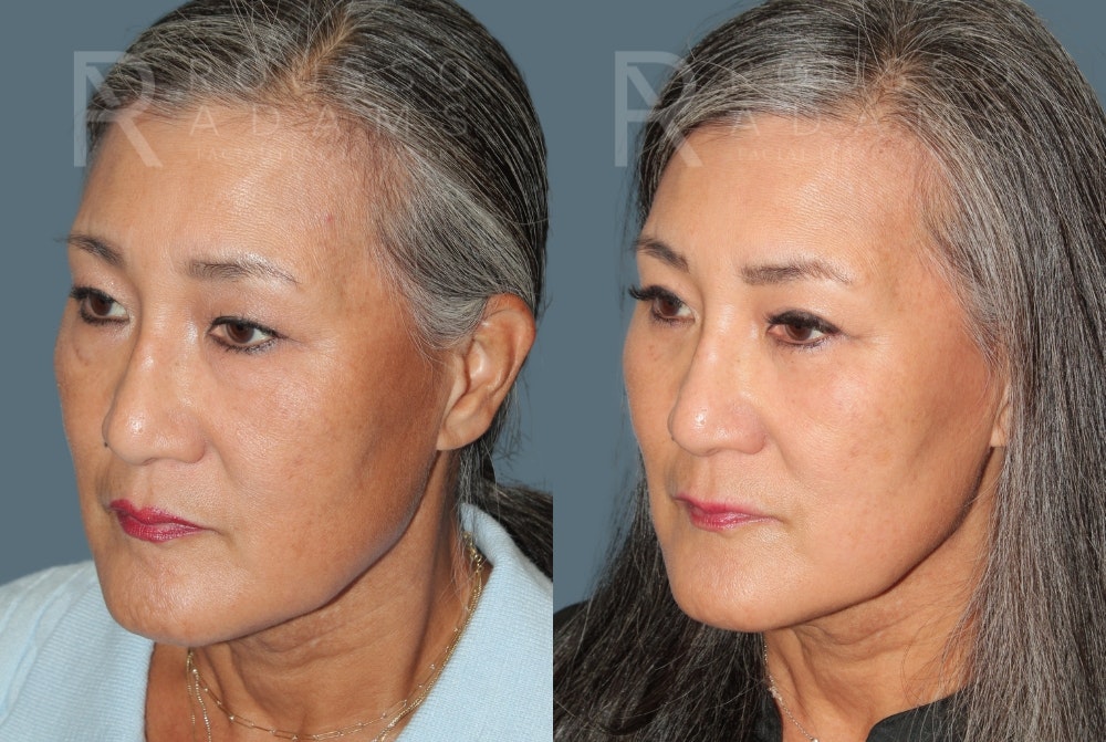 Blepharoplasty<span class=small>By Dr. Austin Adams</span> Before & After Gallery - Patient 266056 - Image 2