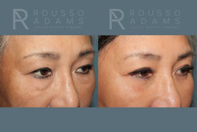 Blepharoplasty<span class=small>By Dr. Austin Adams</span> Before & After Gallery - Patient 266056 - Image 1