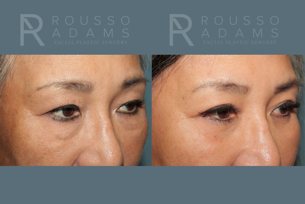 Blepharoplasty<span class=small>By Dr. Austin Adams</span> Before & After Gallery - Patient 266056 - Image 1