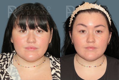 Acculift <span class=small>By Dr. Austin Adams</span> Before & After Gallery - Patient 210684 - Image 2
