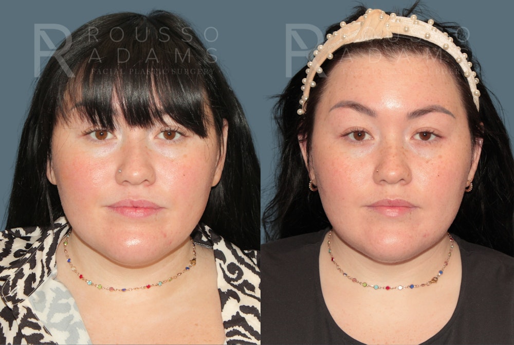 Acculift <span class=small>By Dr. Austin Adams</span> Before & After Gallery - Patient 210684 - Image 2