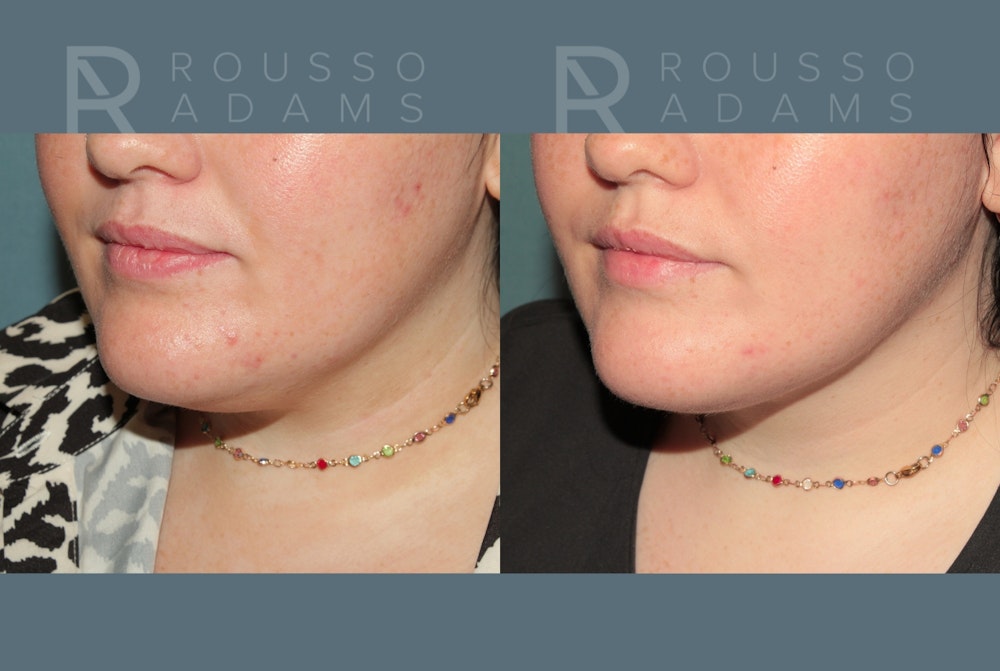 Acculift <span class=small>By Dr. Austin Adams</span> Before & After Gallery - Patient 210684 - Image 3