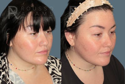 Acculift <span class=small>By Dr. Austin Adams</span> Before & After Gallery - Patient 210684 - Image 1
