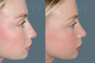 Rhinoplasty<span class=small>By Dr. Austin Adams</span> Before & After Gallery - Patient 150037 - Image 1
