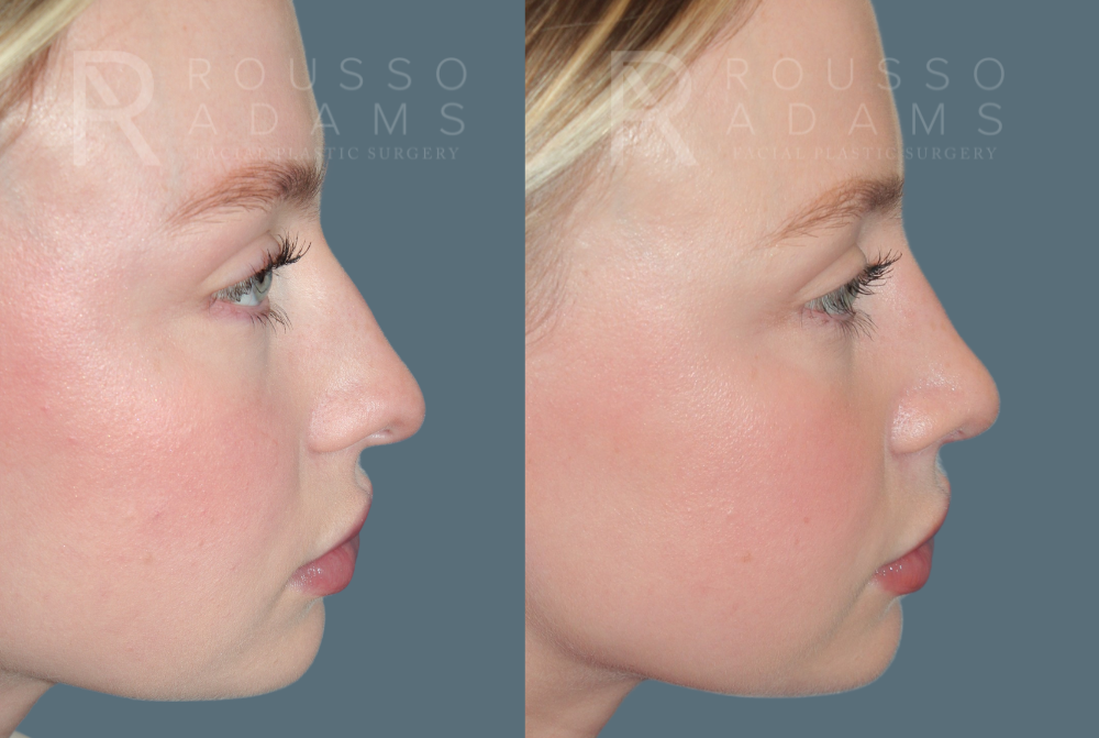 Rhinoplasty<span class=small>By Dr. Austin Adams</span> Before & After Gallery - Patient 150037 - Image 1