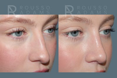 Rhinoplasty<span class=small>By Dr. Austin Adams</span> Before & After Gallery - Patient 150037 - Image 2