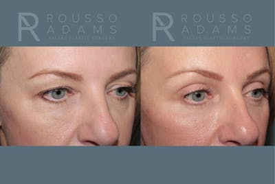 Blepharoplasty<span class=small>By Dr. Austin Adams</span> Before & After Gallery - Patient 409651 - Image 2
