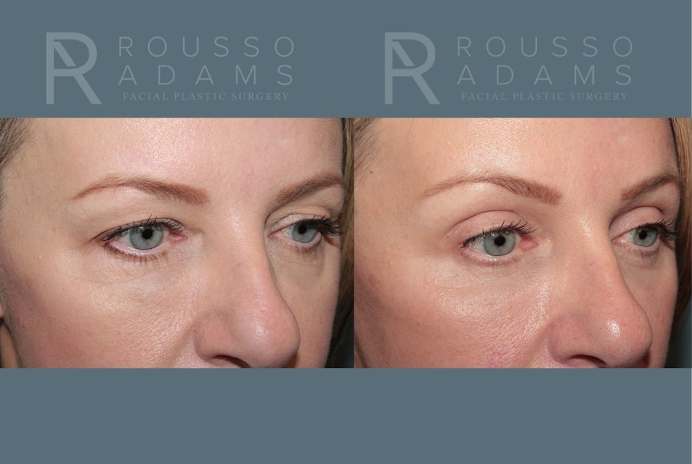 Blepharoplasty<span class=small>By Dr. Austin Adams</span> Before & After Gallery - Patient 409651 - Image 2