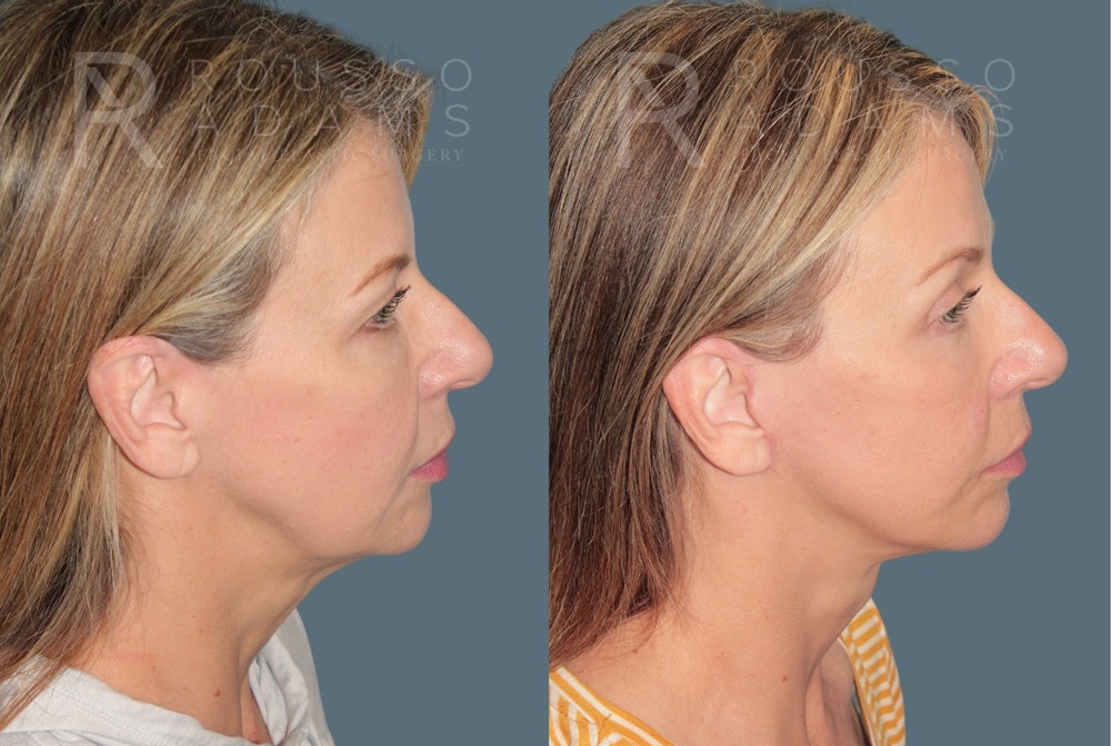 Deep Plane Facelift <span class=small>By Dr. Austin Adams</span> Before & After Gallery - Patient 383706 - Image 3