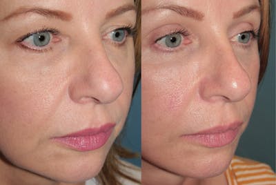 Deep Plane Facelift <span class=small>By Dr. Austin Adams</span> Before & After Gallery - Patient 383706 - Image 4