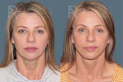 Deep Plane Facelift <span class=small>By Dr. Austin Adams</span> Before & After Gallery - Patient 383706 - Image 2