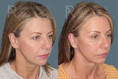 Deep Plane Facelift <span class=small>By Dr. Austin Adams</span> Before & After Gallery - Patient 383706 - Image 1