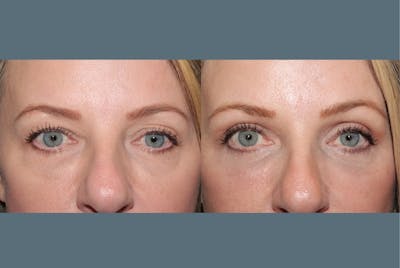 Blepharoplasty<span class=small>By Dr. Austin Adams</span> Before & After Gallery - Patient 409651 - Image 1