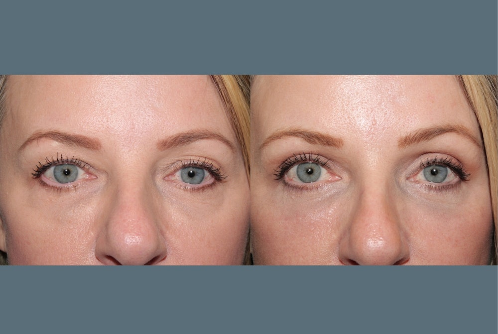 Blepharoplasty<span class=small>By Dr. Austin Adams</span> Before & After Gallery - Patient 409651 - Image 1