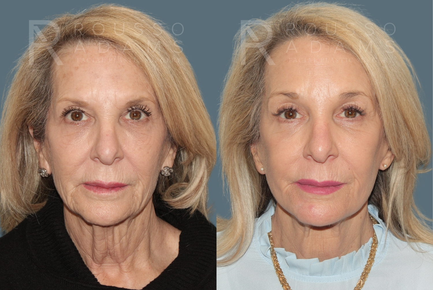 Patient 394175 | Gallery | Rousso Adams Facial Plastic Surgery