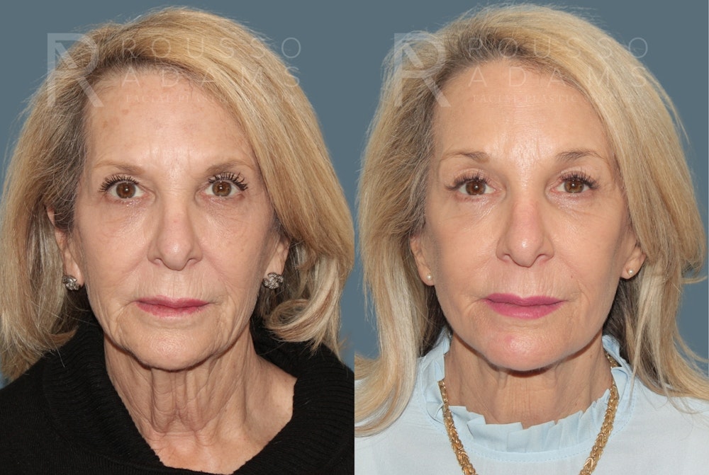 Deep Plane Facelift <span class=small>By Dr. Austin Adams</span> Before & After Gallery - Patient 394175 - Image 3