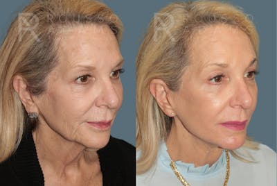 Deep Plane Facelift <span class=small>By Dr. Austin Adams</span> Before & After Gallery - Patient 394175 - Image 1