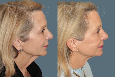Deep Plane Facelift <span class=small>By Dr. Austin Adams</span> Before & After Gallery - Patient 394175 - Image 2
