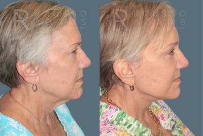 Deep Plane Facelift <span class=small>By Dr. Austin Adams</span> Before & After Gallery - Patient 422164 - Image 2
