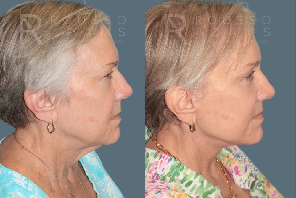 Deep Plane Facelift <span class=small>By Dr. Austin Adams</span> Before & After Gallery - Patient 422164 - Image 2