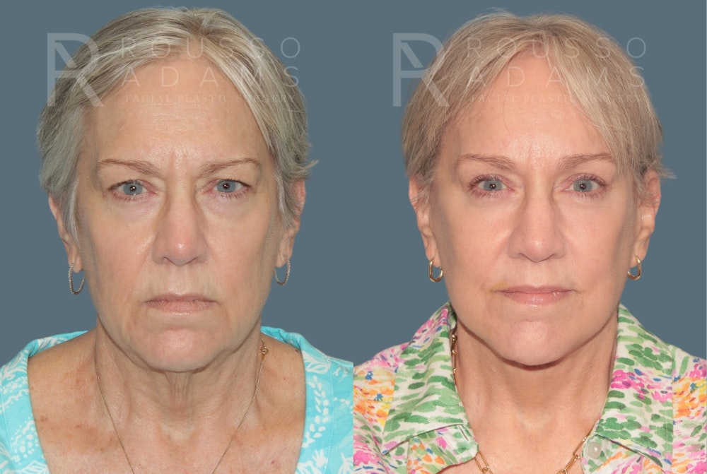 Blepharoplasty<span class=small>By Dr. Austin Adams</span> Before & After Gallery - Patient 424623 - Image 3
