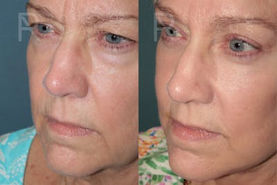 Deep Plane Facelift <span class=small>By Dr. Austin Adams</span> Before & After Gallery - Patient 422164 - Image 4