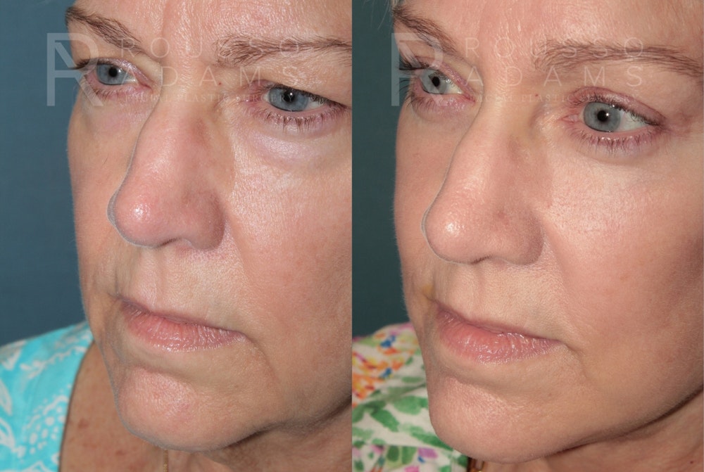 Deep Plane Facelift <span class=small>By Dr. Austin Adams</span> Before & After Gallery - Patient 422164 - Image 4
