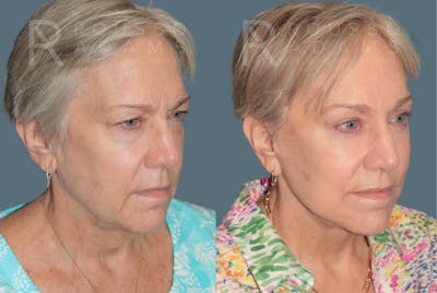Deep Plane Facelift <span class=small>By Dr. Austin Adams</span> Before & After Gallery - Patient 422164 - Image 1