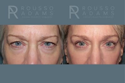 Blepharoplasty<span class=small>By Dr. Austin Adams</span> Before & After Gallery - Patient 424623 - Image 1