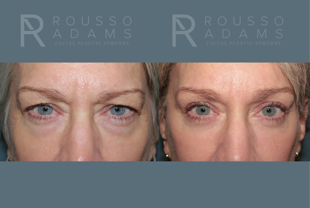 Blepharoplasty<span class=small>By Dr. Austin Adams</span> Before & After Gallery - Patient 424623 - Image 1