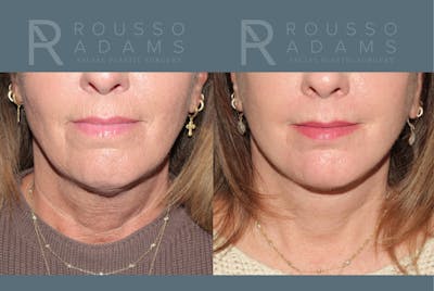 Deep Plane Facelift <span class=small>By Dr. Austin Adams</span> Before & After Gallery - Patient 918127 - Image 4