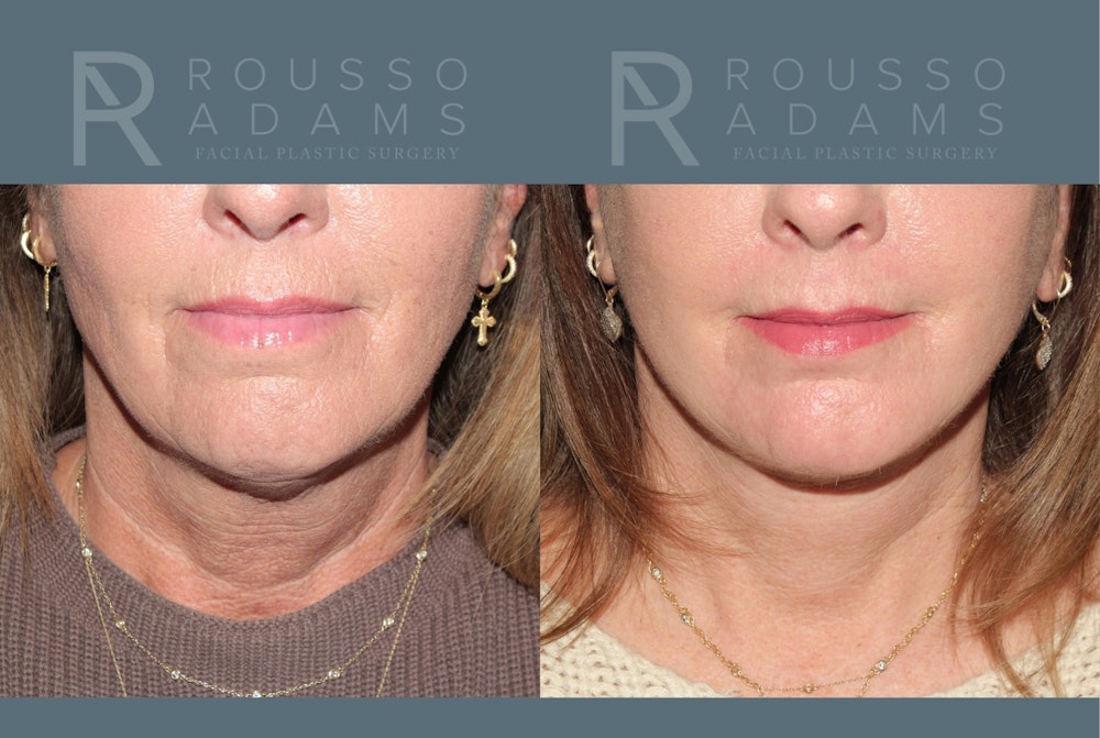 Deep Plane Facelift <span class=small>By Dr. Austin Adams</span> Before & After Gallery - Patient 918127 - Image 4
