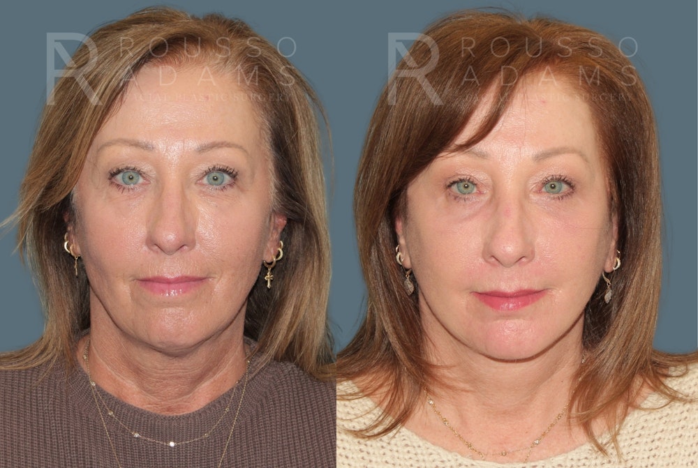 Deep Plane Facelift <span class=small>By Dr. Austin Adams</span> Before & After Gallery - Patient 918127 - Image 3