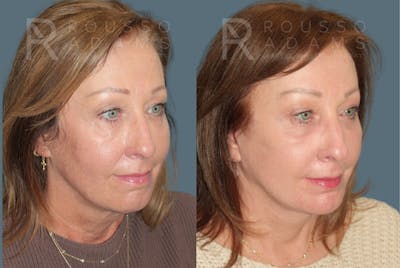 Deep Plane Facelift <span class=small>By Dr. Austin Adams</span> Before & After Gallery - Patient 918127 - Image 1