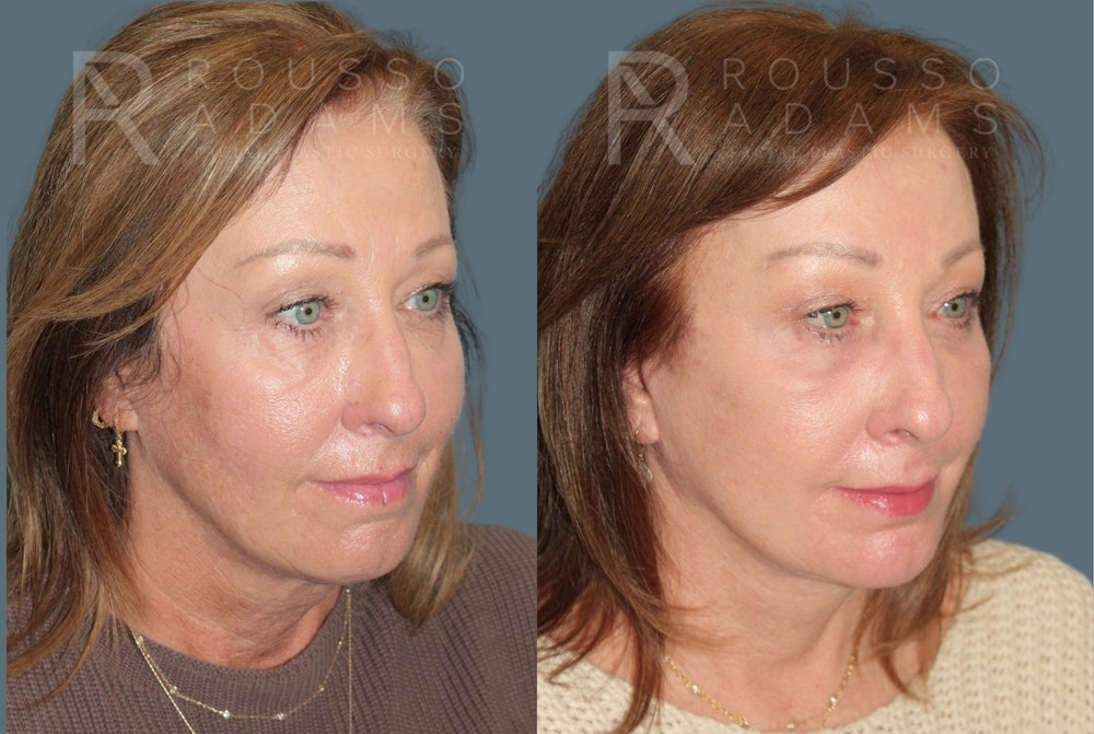 Deep Plane Facelift <span class=small>By Dr. Austin Adams</span> Before & After Gallery - Patient 918127 - Image 1