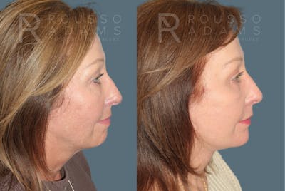 Deep Plane Facelift <span class=small>By Dr. Austin Adams</span> Before & After Gallery - Patient 918127 - Image 2