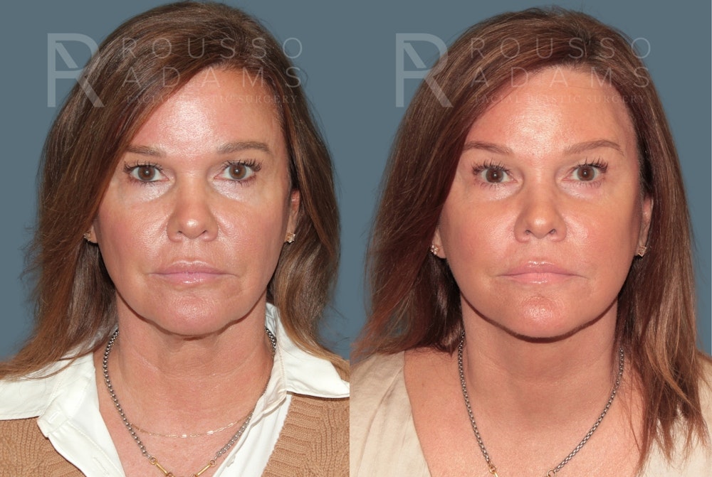 Deep Plane Facelift <span class=small>By Dr. Austin Adams</span> Before & After Gallery - Patient 404827 - Image 3