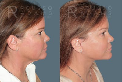 Deep Plane Facelift <span class=small>By Dr. Austin Adams</span> Before & After Gallery - Patient 404827 - Image 2