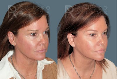 Deep Plane Facelift <span class=small>By Dr. Austin Adams</span> Before & After Gallery - Patient 404827 - Image 1