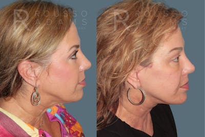 Deep Plane Facelift <span class=small>By Dr. Austin Adams</span> Before & After Gallery - Patient 278208 - Image 2