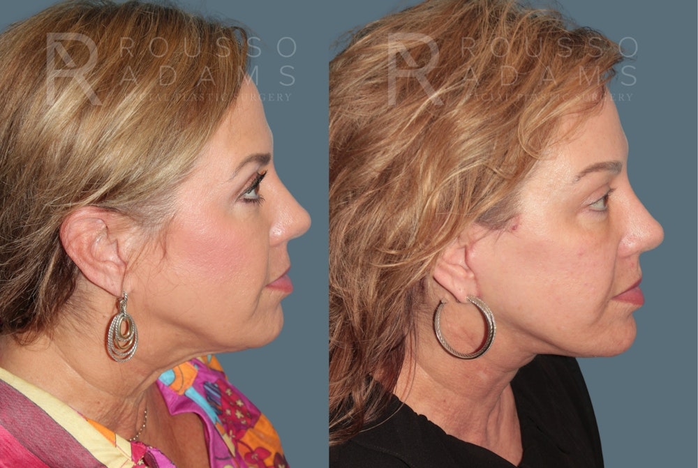 Deep Plane Facelift <span class=small>By Dr. Austin Adams</span> Before & After Gallery - Patient 278208 - Image 2