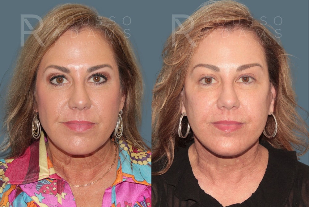 Deep Plane Facelift <span class=small>By Dr. Austin Adams</span> Before & After Gallery - Patient 278208 - Image 3