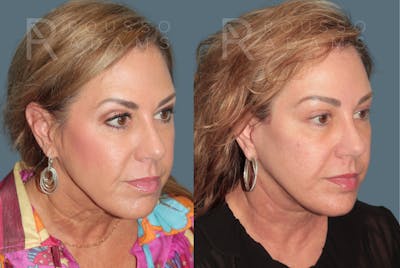 Deep Plane Facelift <span class=small>By Dr. Austin Adams</span> Before & After Gallery - Patient 278208 - Image 1