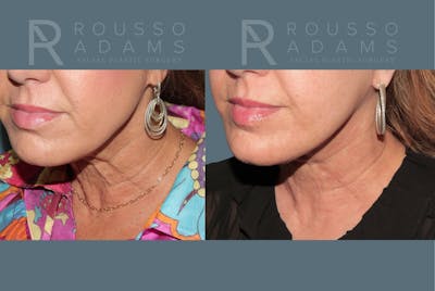 Deep Plane Facelift <span class=small>By Dr. Austin Adams</span> Before & After Gallery - Patient 278208 - Image 4
