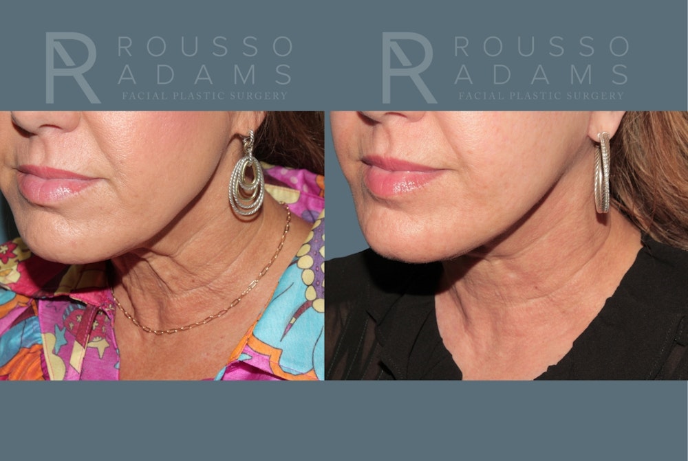 Deep Plane Facelift <span class=small>By Dr. Austin Adams</span> Before & After Gallery - Patient 278208 - Image 4
