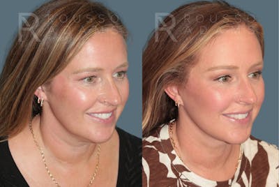 Blepharoplasty<span class=small>By Dr. Austin Adams</span> Before & After Gallery - Patient 885836 - Image 2