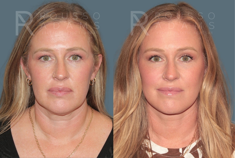 Blepharoplasty<span class=small>By Dr. Austin Adams</span> Before & After Gallery - Patient 885836 - Image 3