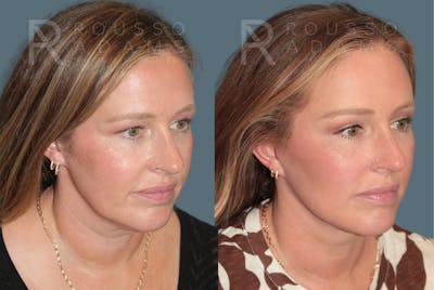 Deep Plane Facelift <span class=small>By Dr. Austin Adams</span> Before & After Gallery - Patient 361512 - Image 1