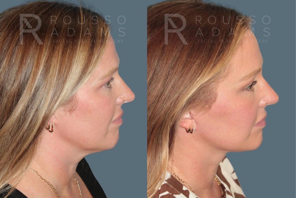 Deep Plane Facelift <span class=small>By Dr. Austin Adams</span> Before & After Gallery - Patient 361512 - Image 3