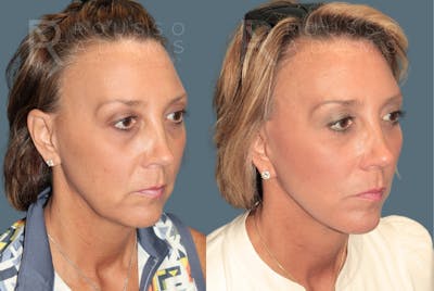 MiniLift<span class=small>By Dr. Austin Adams</span> Before & After Gallery - Patient 243135 - Image 2